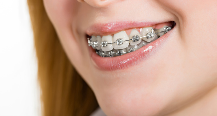 Beugels orthodontie